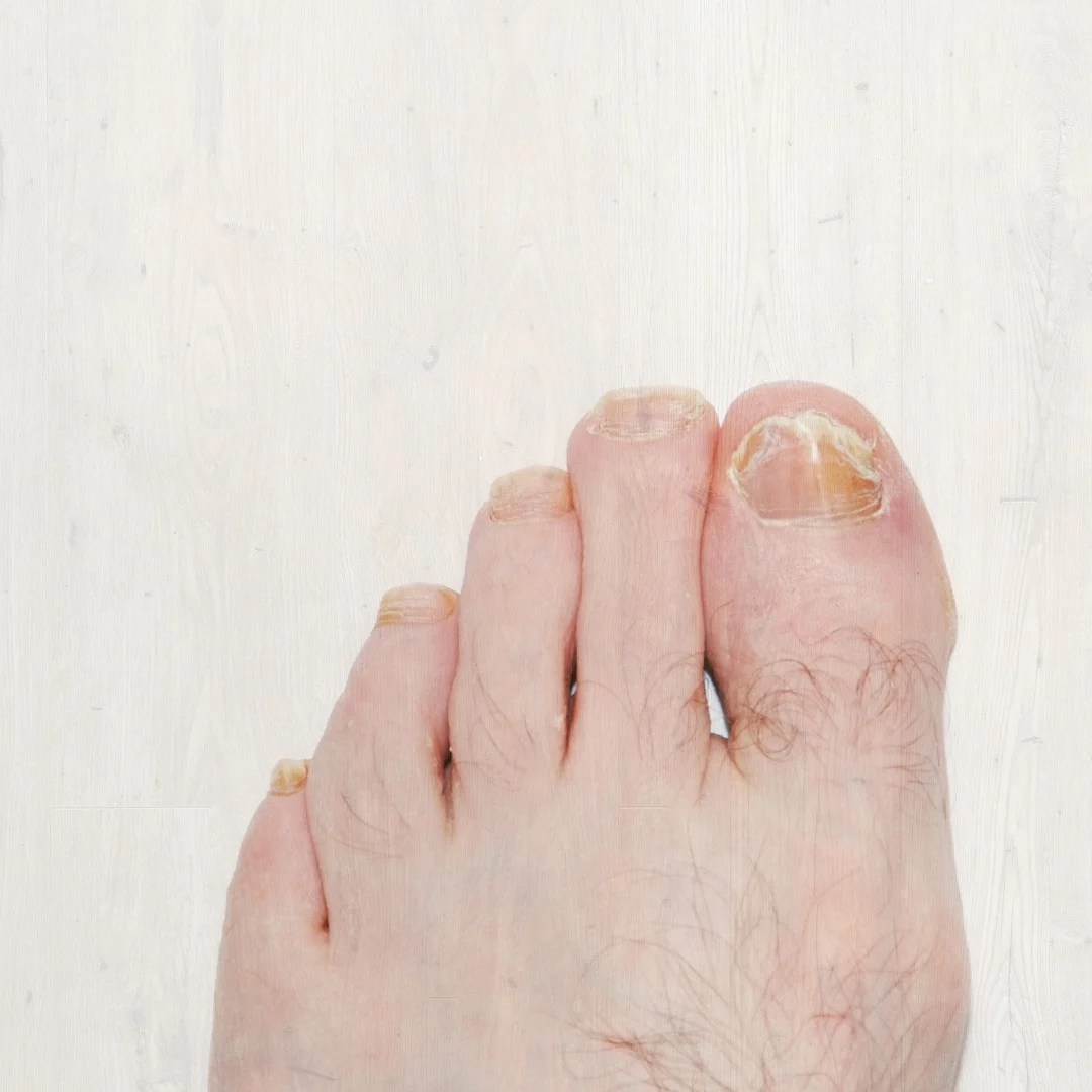 Can Toenail Fungus Be Harmful? Exploring Foot Treatment Options