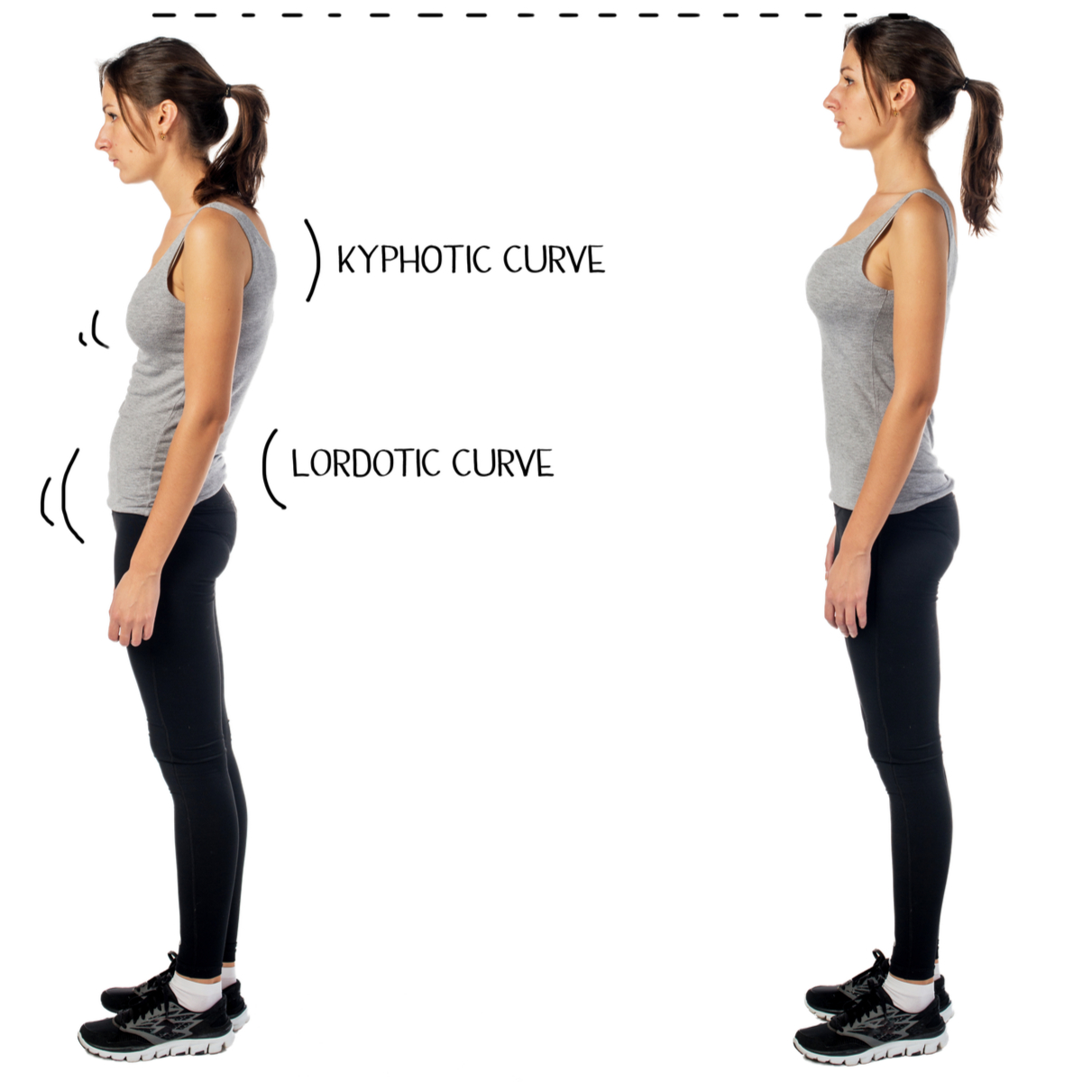 Kyphosis Spine Surgeons North Jersey Spine Group
