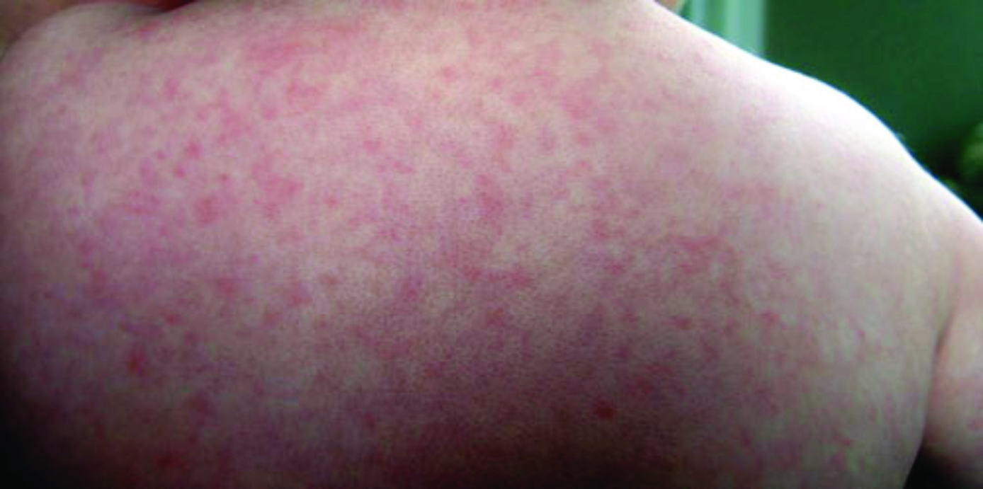 Pediatric Skin Conditions | Northpointe Medical