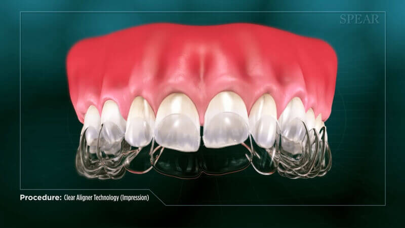 Invisalign