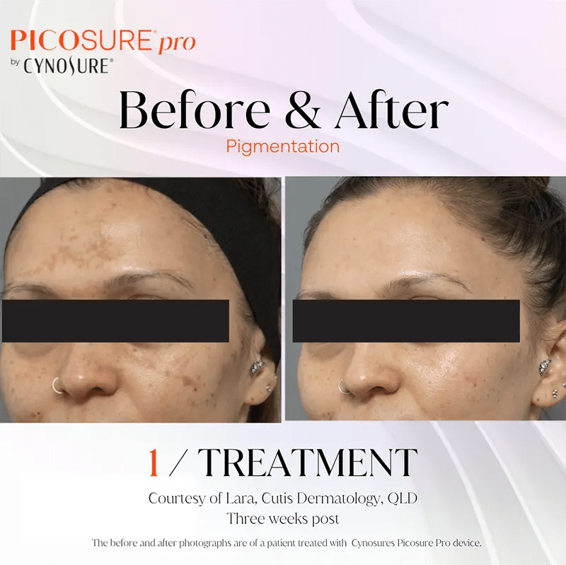PicoSure Pro Laser Melbourne Pigmentation specialist