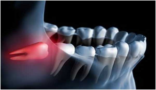 Wisdom Teeth Removal in Carrollton, TX North Texas Dental Surgery