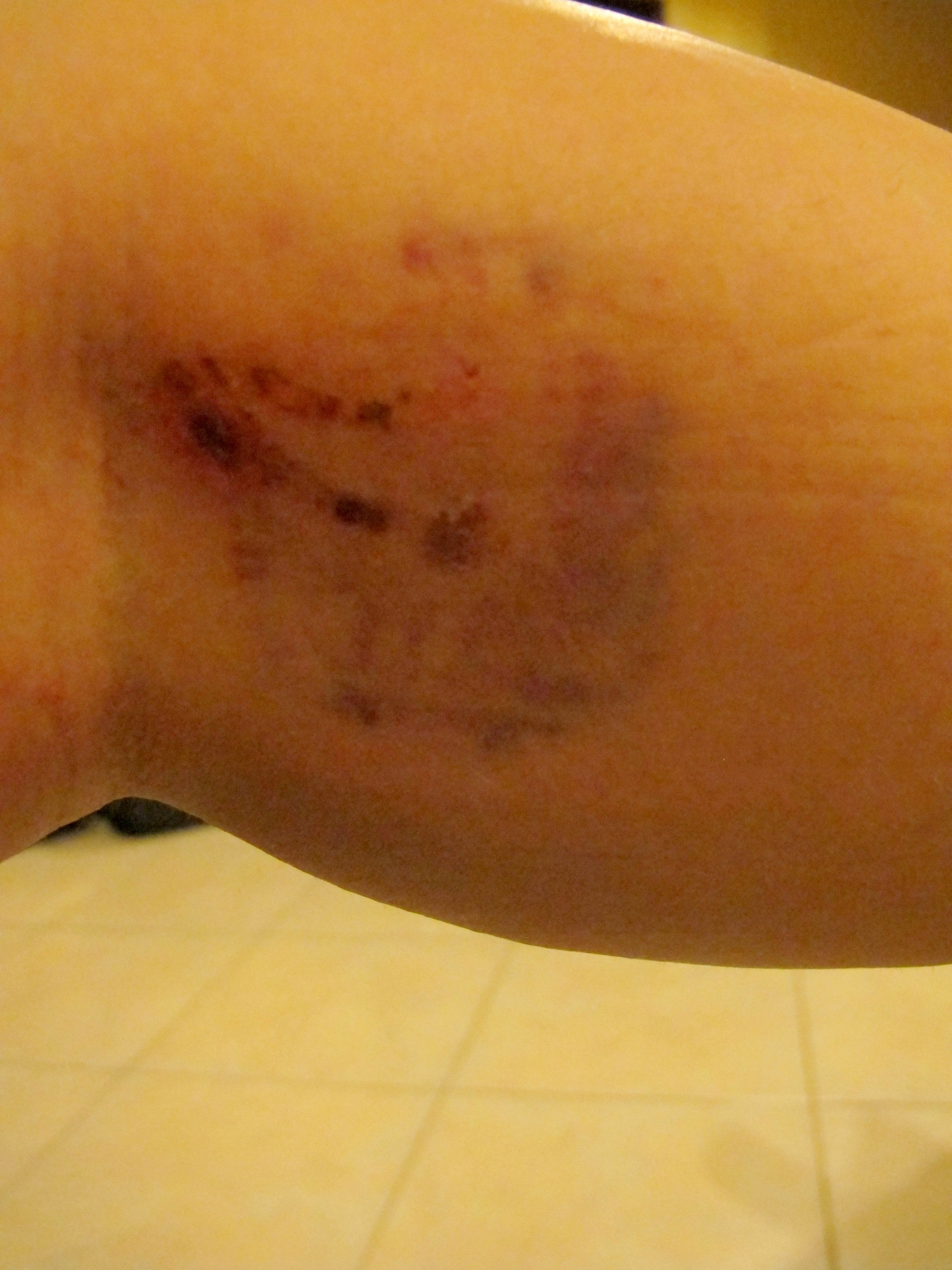 Dog Bites & Rabies Shots