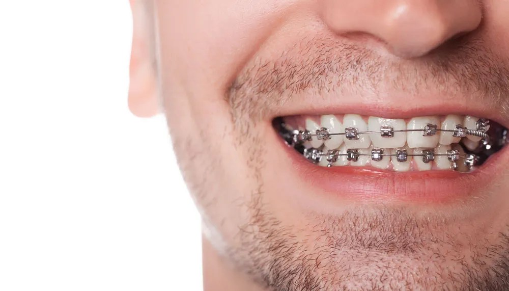 Brackets autoligados Novalign