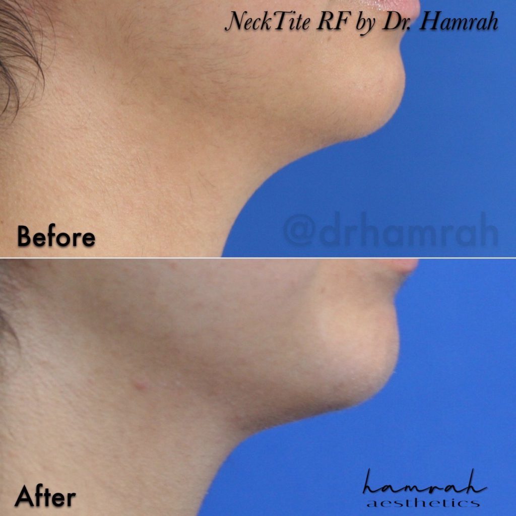 NonSurgical Face and Neck Tightening Nova Surgicare