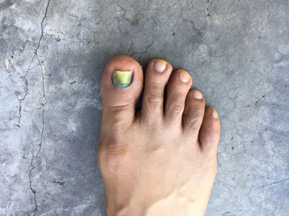 Why Are My Toes Turning Black? Now Then Digital