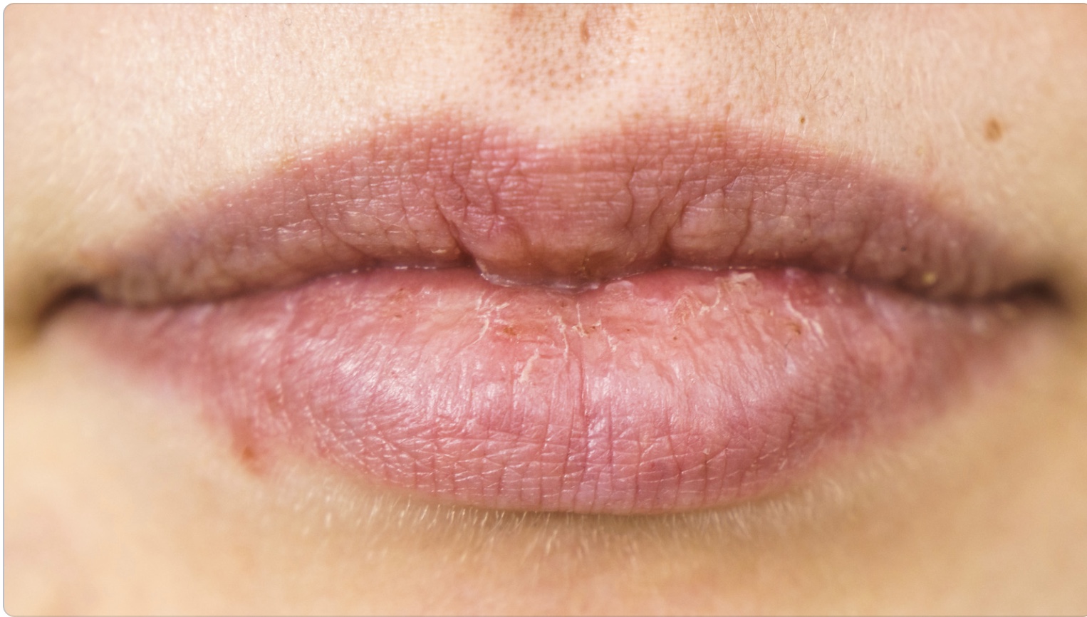 Is it a cold sore or a pimple? NowPatient