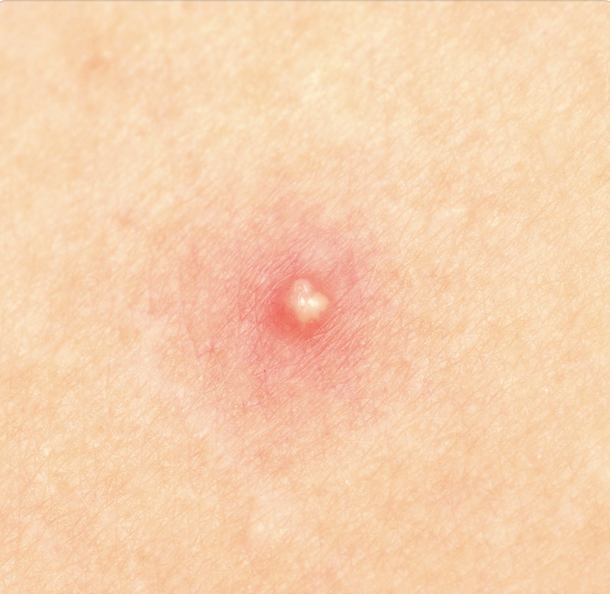 How to pop a pimple NowPatient