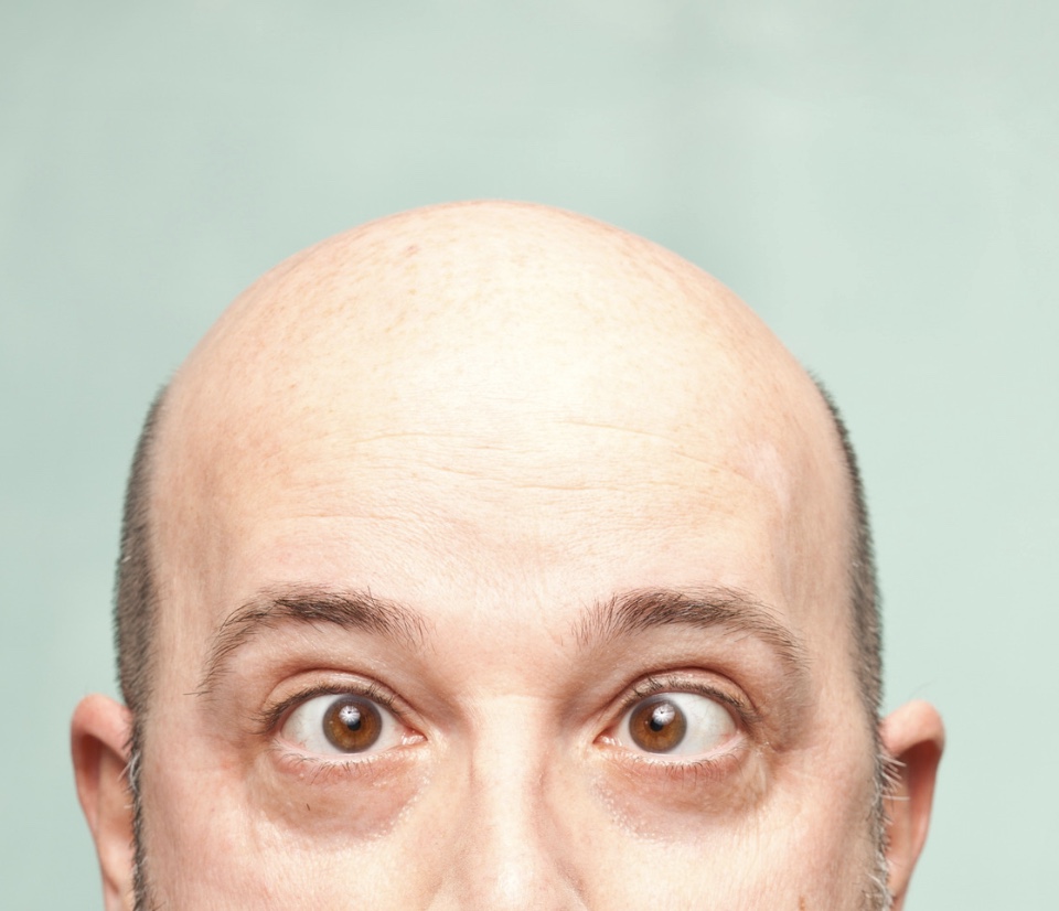 Is there a cure for baldness? NowPatient