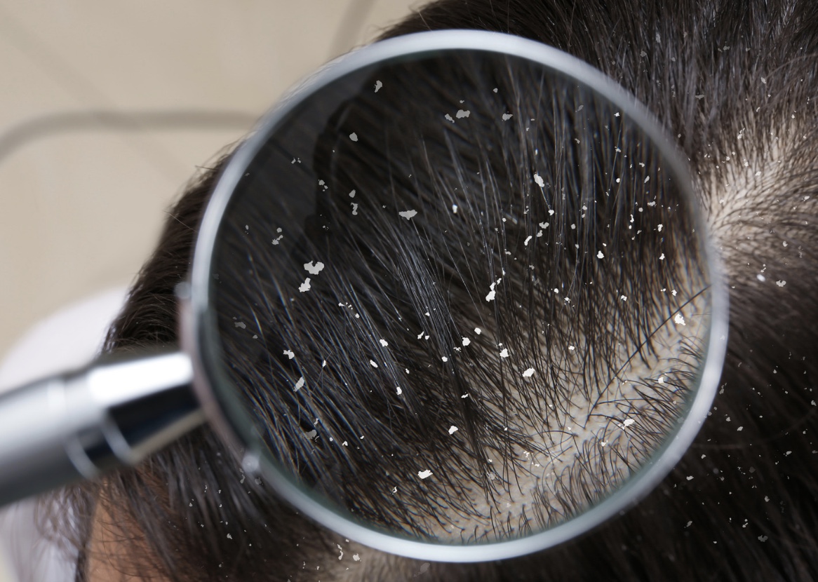 Why do I have dandruff? NowPatient