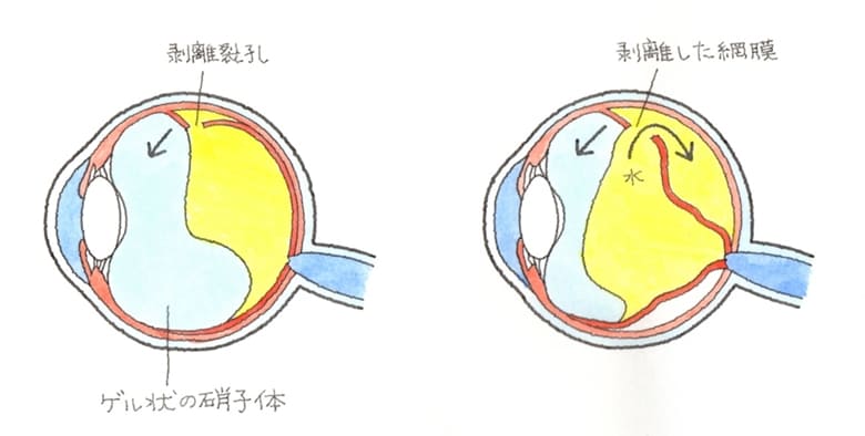 10+ 網膜 剥離 保険 給付 金 References