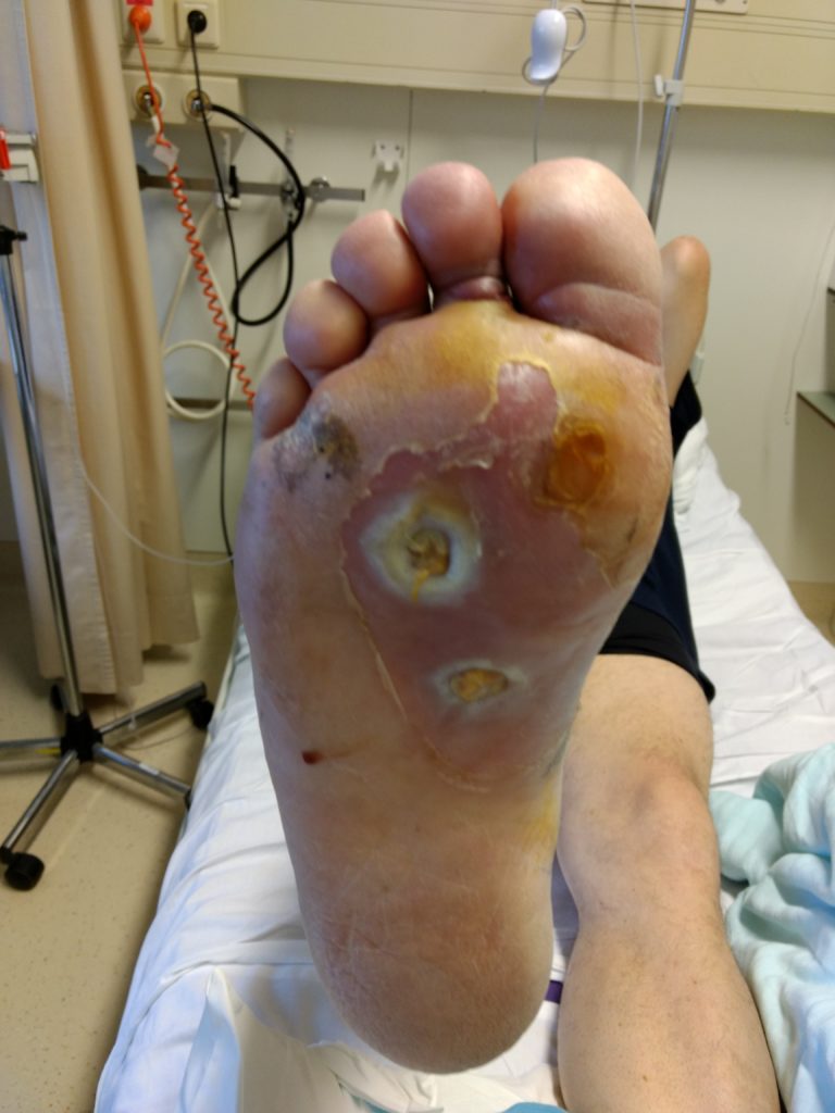 V.A.C. VERAFLO™ Therapy with V.A.C. VERAFLO™ Dressing A