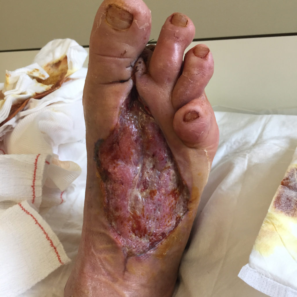 V.A.C. VERAFLO™ Therapy with V.A.C. VERAFLO™ Dressing A complicated