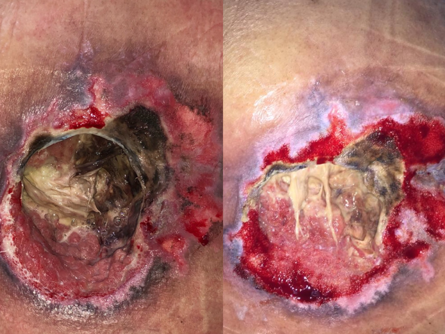 TREATMENT OF INFECTED SACRAL PRESSURE ULCER WITH NEGATIVE