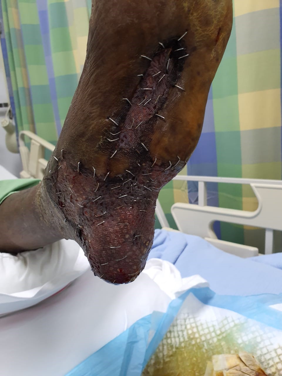 Use of Veraflo therapy on a complex Diabetic foot ulcer
