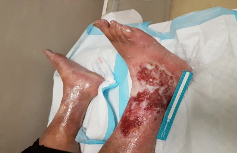 V.A.C. VERAFLOTM Therapy with V.A.C. VERAFLO CLEANSE TM