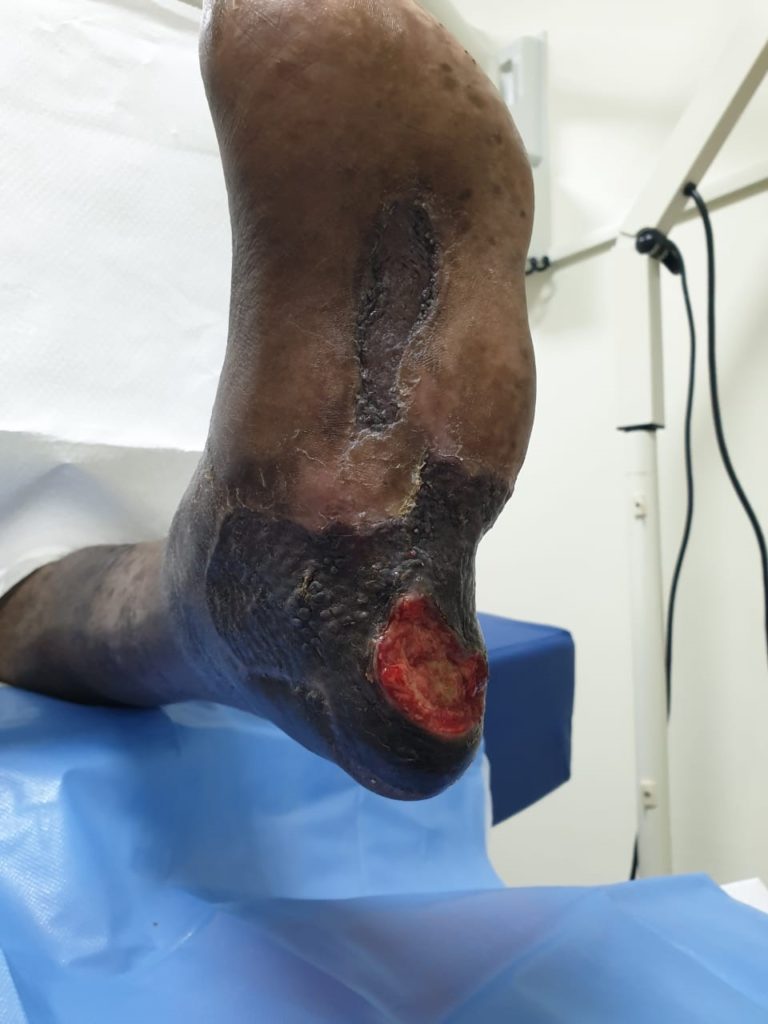Use of Veraflo therapy on a complex Diabetic foot ulcer