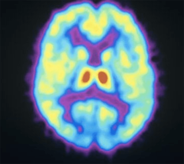 Gambling Addiction and the Brain