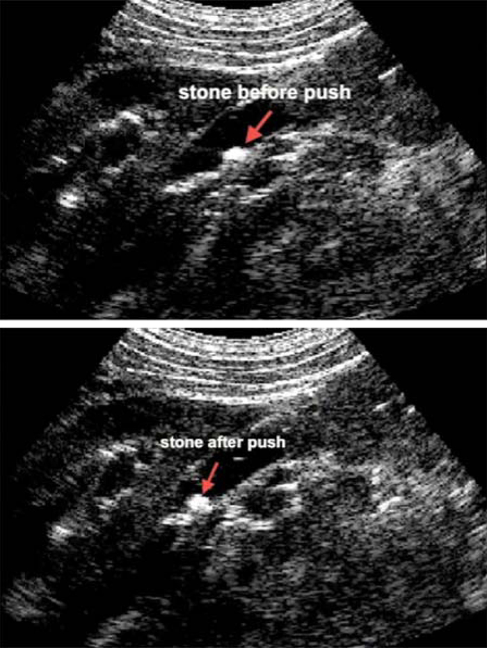Kidney Stone Ultrasound