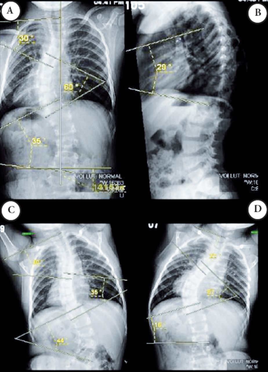 The use of controlled growing rod device for pediatric