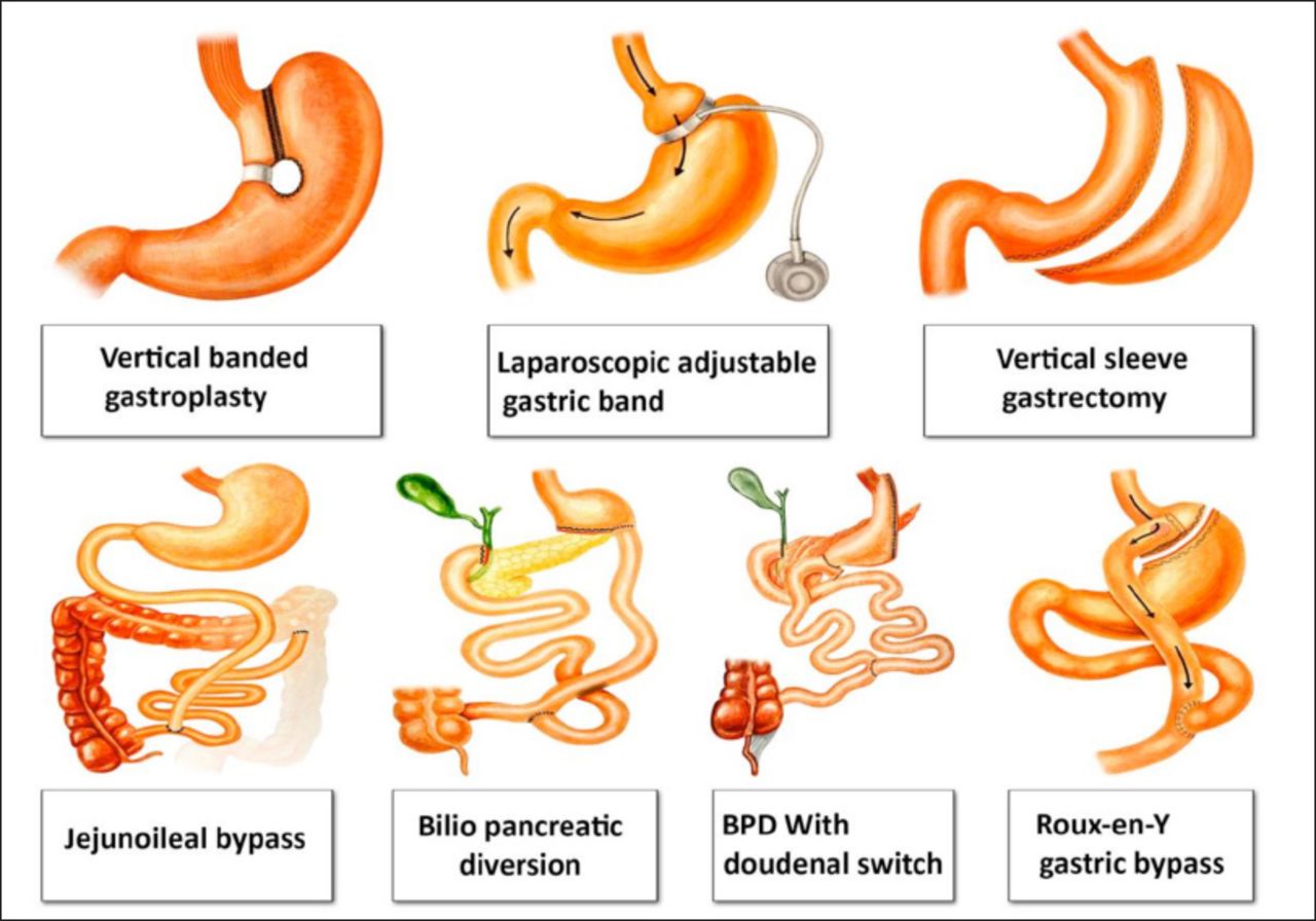 Neurological complications of bariatric surgery Neurosciences Journal