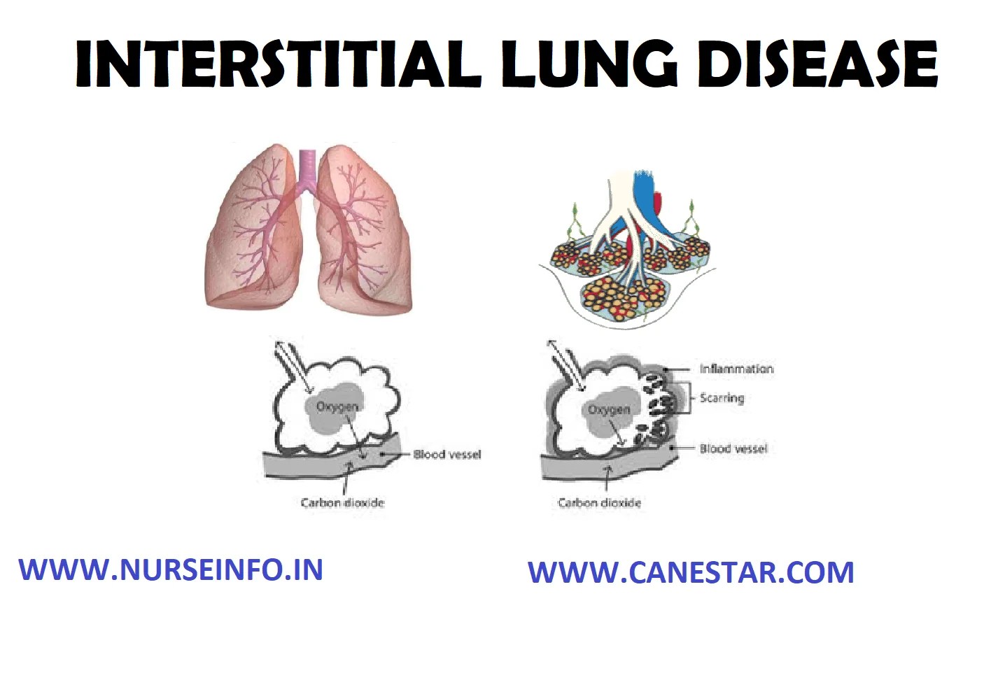 Interstitial Lung Disease Pathophysiology