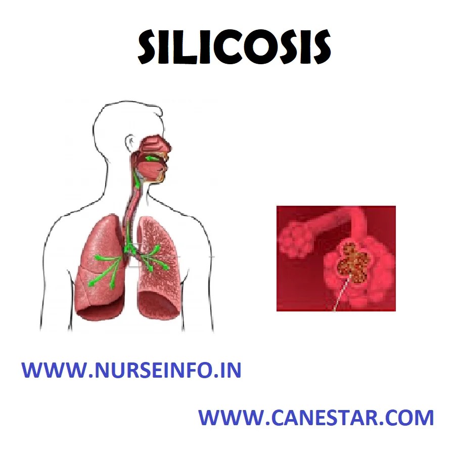 SILICOSIS Nurse Info