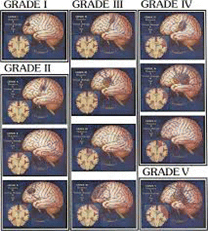 Markwalder Classification Neurovascular Disease | Nurse Key