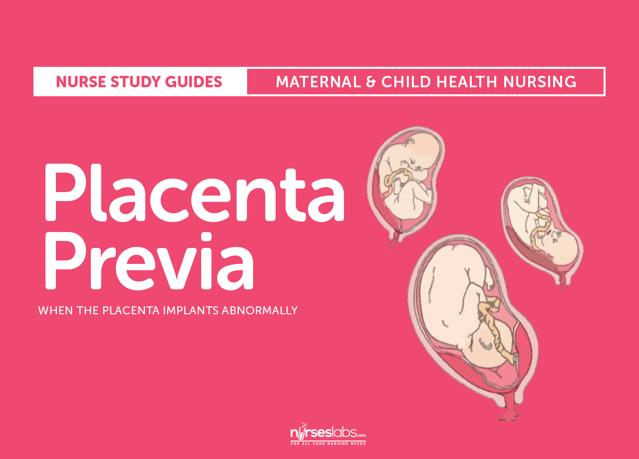 Placenta Previa Nursing Care Plan and Management