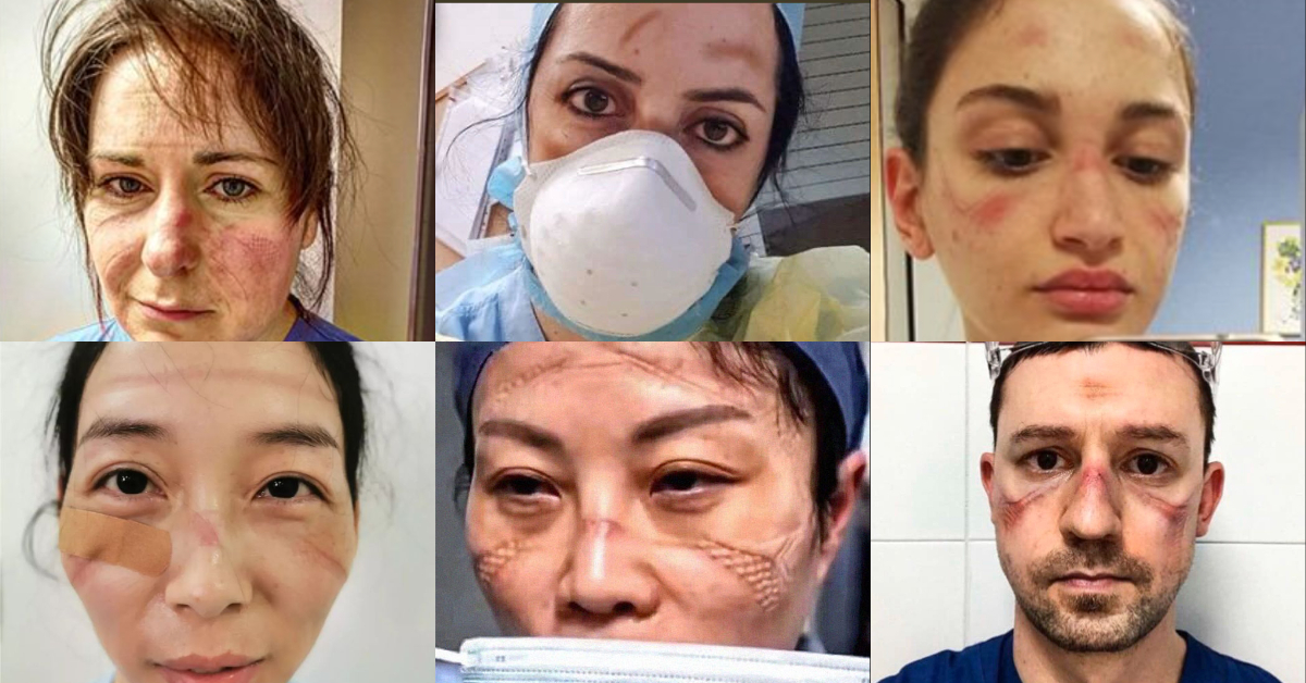 8 Tips to Avoid Skin Damage While Wearing PPE Nurseslabs