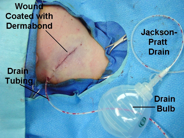 Care of the Jackson Pratt Drain Nursing Crib