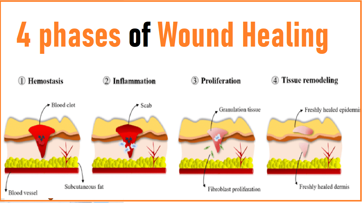 Phases Of Wound Healing(03)