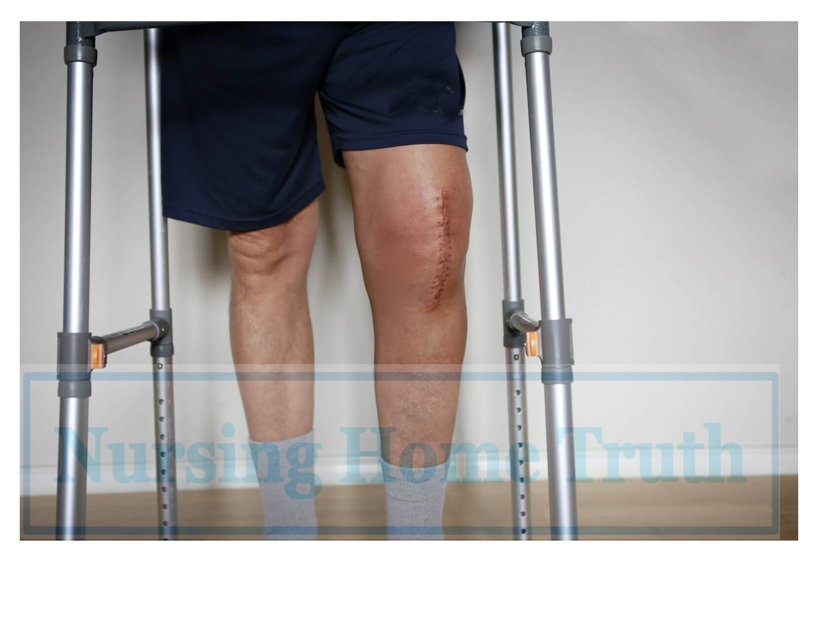 Knee Surgery Verdicts and Settlements ***(2022 Update)***