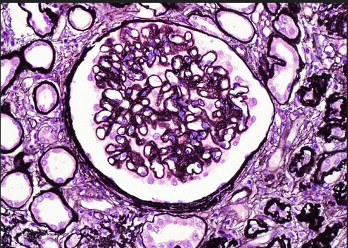 glomerulonephritis (gn)