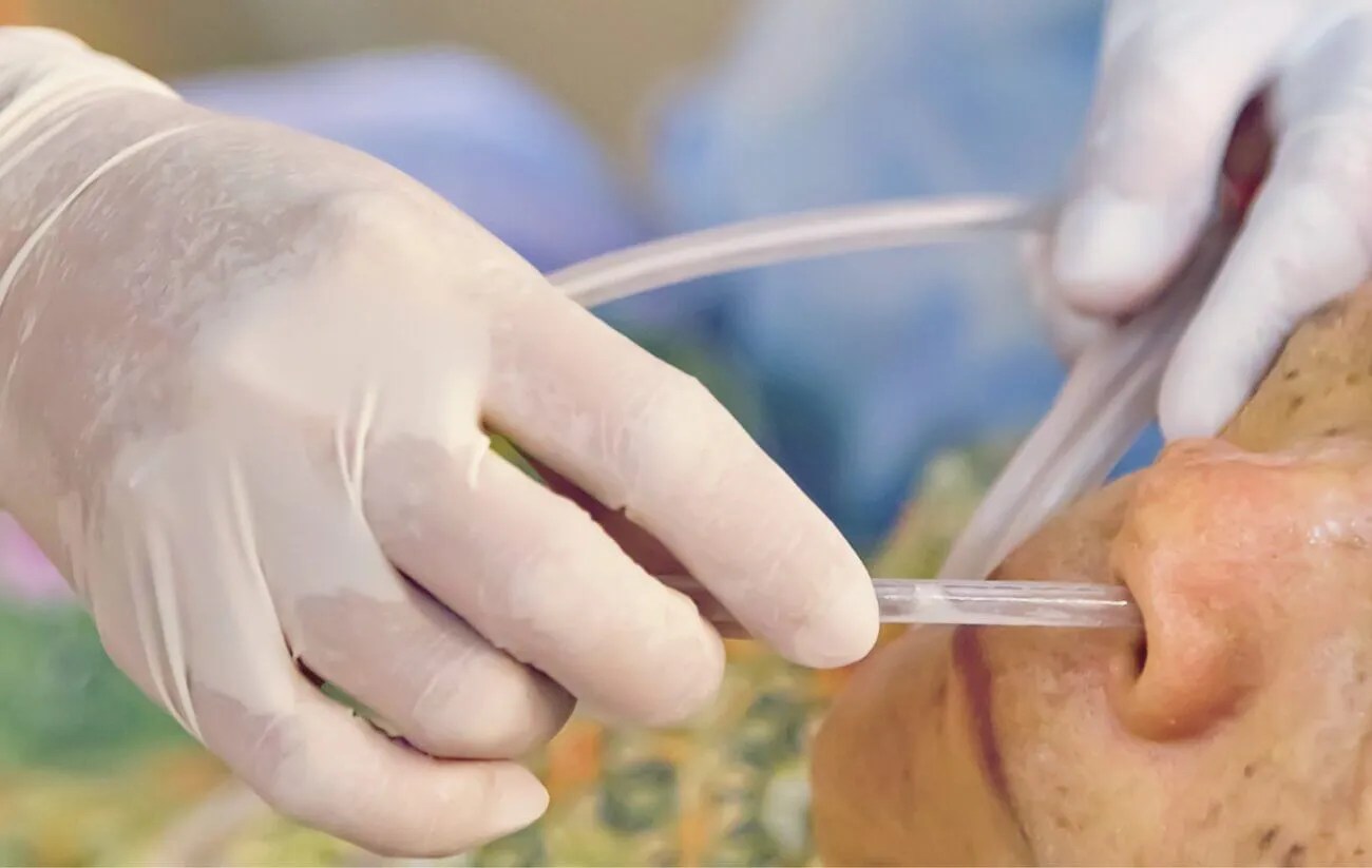 NG tube insertion deemed aerosol generating procedure NursingNotes