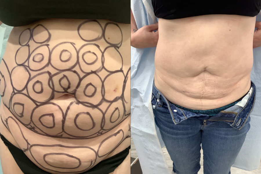 SmartLipo NJ Nusbaum Medical Centers Medical Weight Loss Surgical