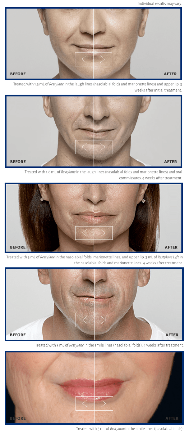 Restylane Before and After Nutfield Eye Associates