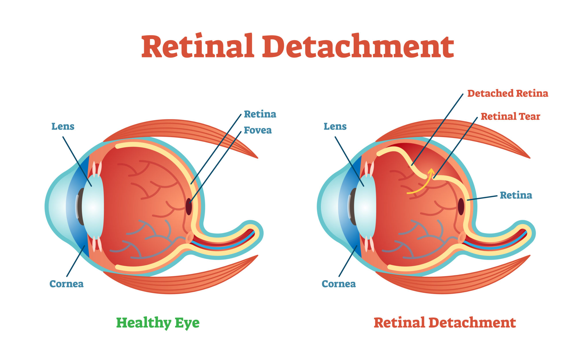 Retinal Detachment What You Need to Know. Nutfield Eye Associates