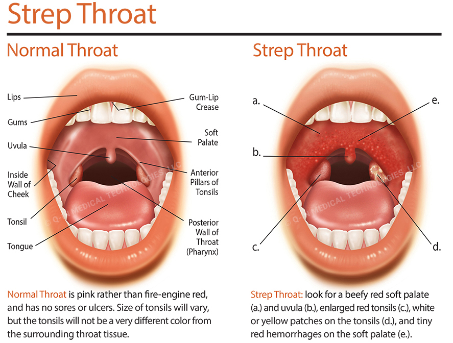 Sore Throat or Strep Throat? How to Tell the Difference