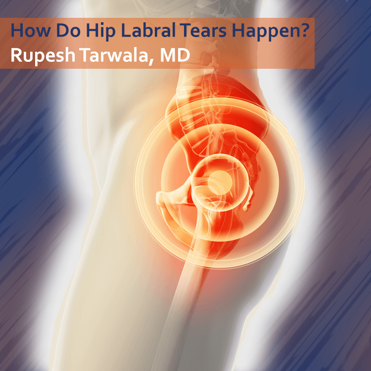Hip Labral Tears What Are They and How Do They Happen? New York Bone