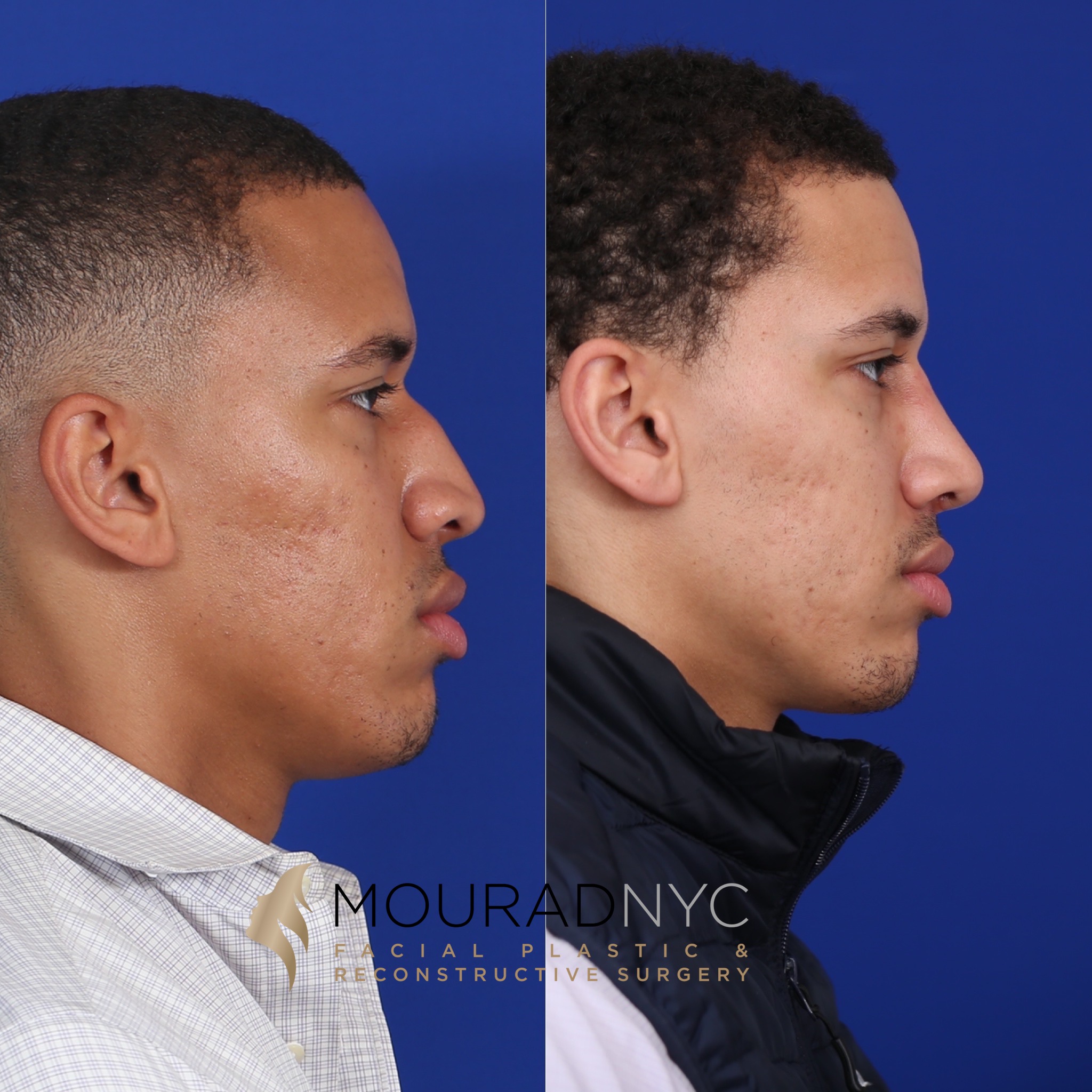 Rhinoplasty & Male Rhinoplasty & Ethnic Rhinoplasty Facial Plastic