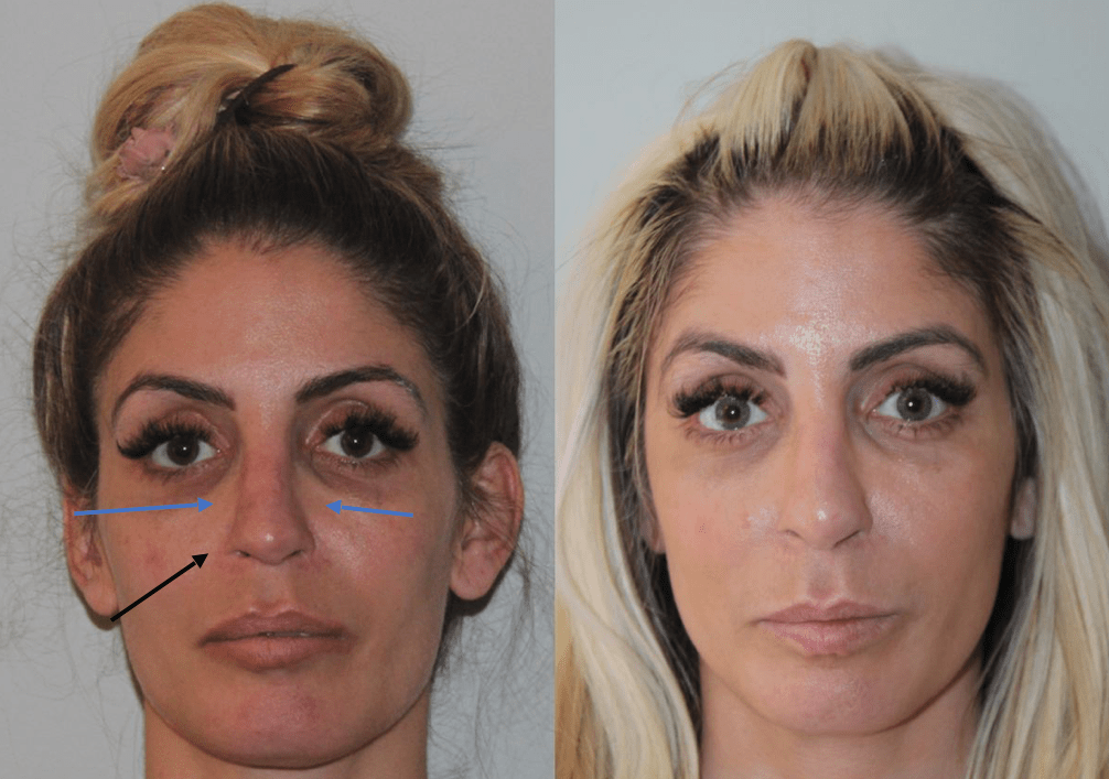 Revision Rhinoplasty Before and After Facial Plastic Surgeon