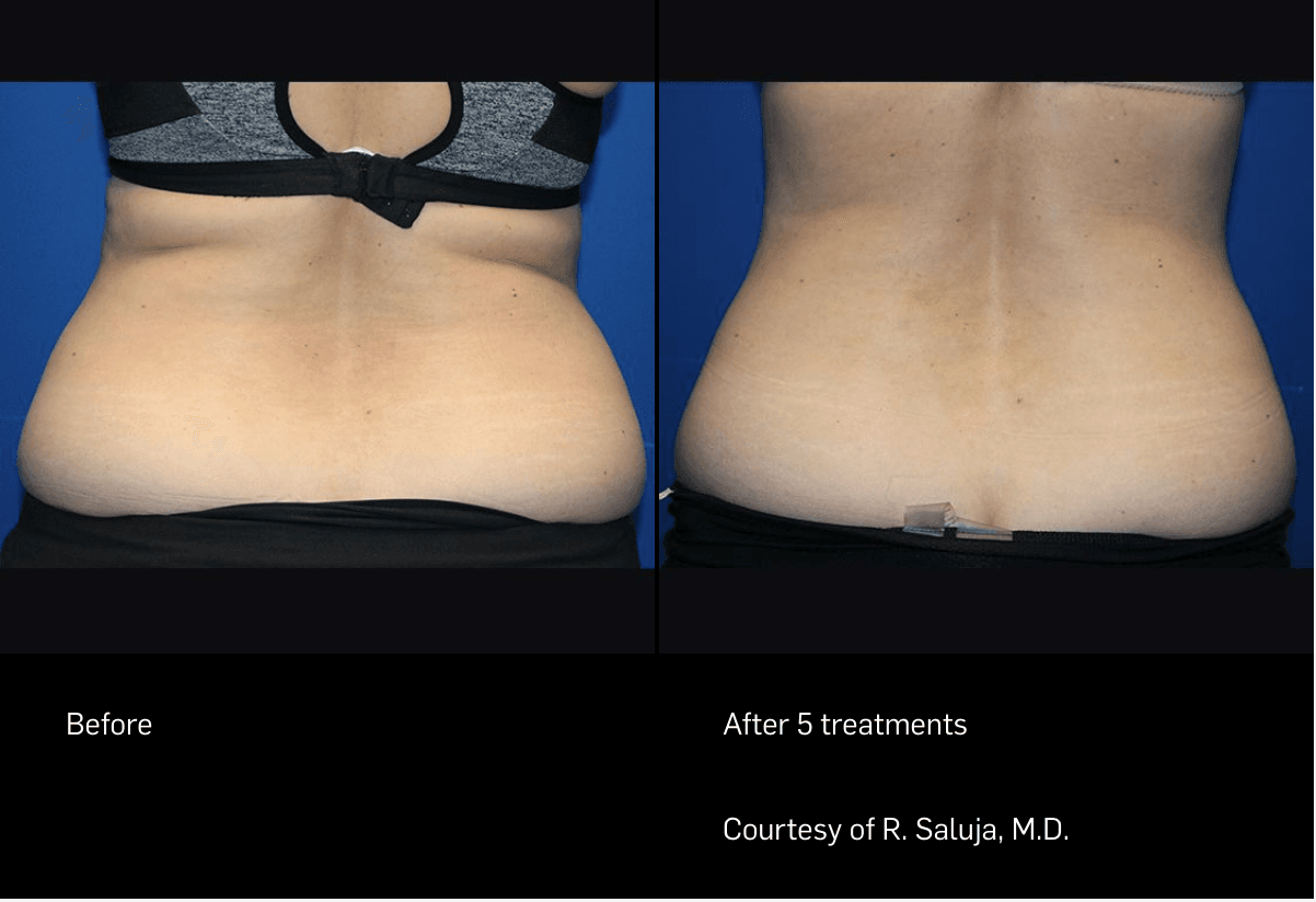 FlexSure™ Before & After Photos Cohen Medical Practice