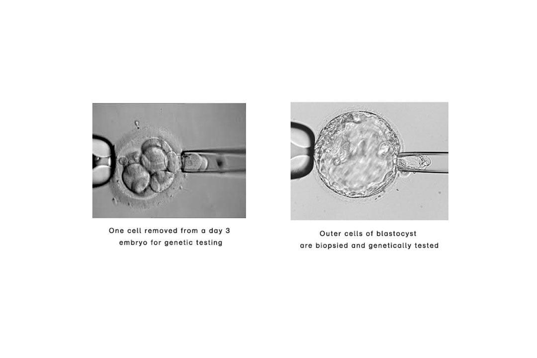 & PGT New York City IVF