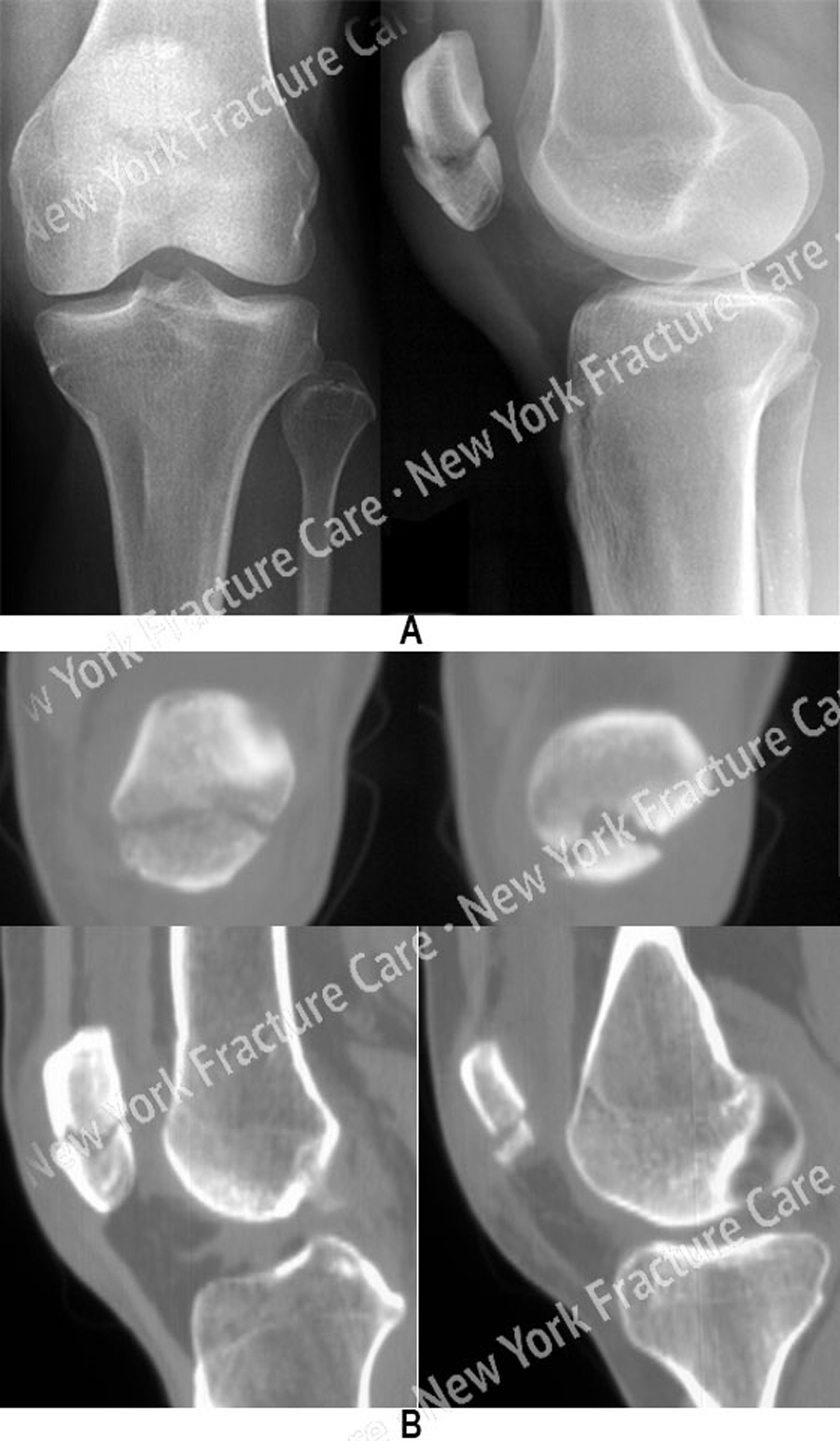 Broken kneecap aftercare: MedlinePlus Medical Encyclopedia