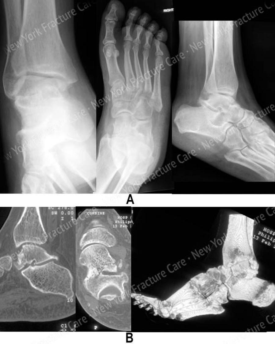 Talus fractures (foot) New York Fracture Care