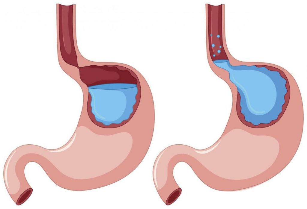 Barrett's esophagus Symptoms, Risk Factors, Diagnosis and Treatment