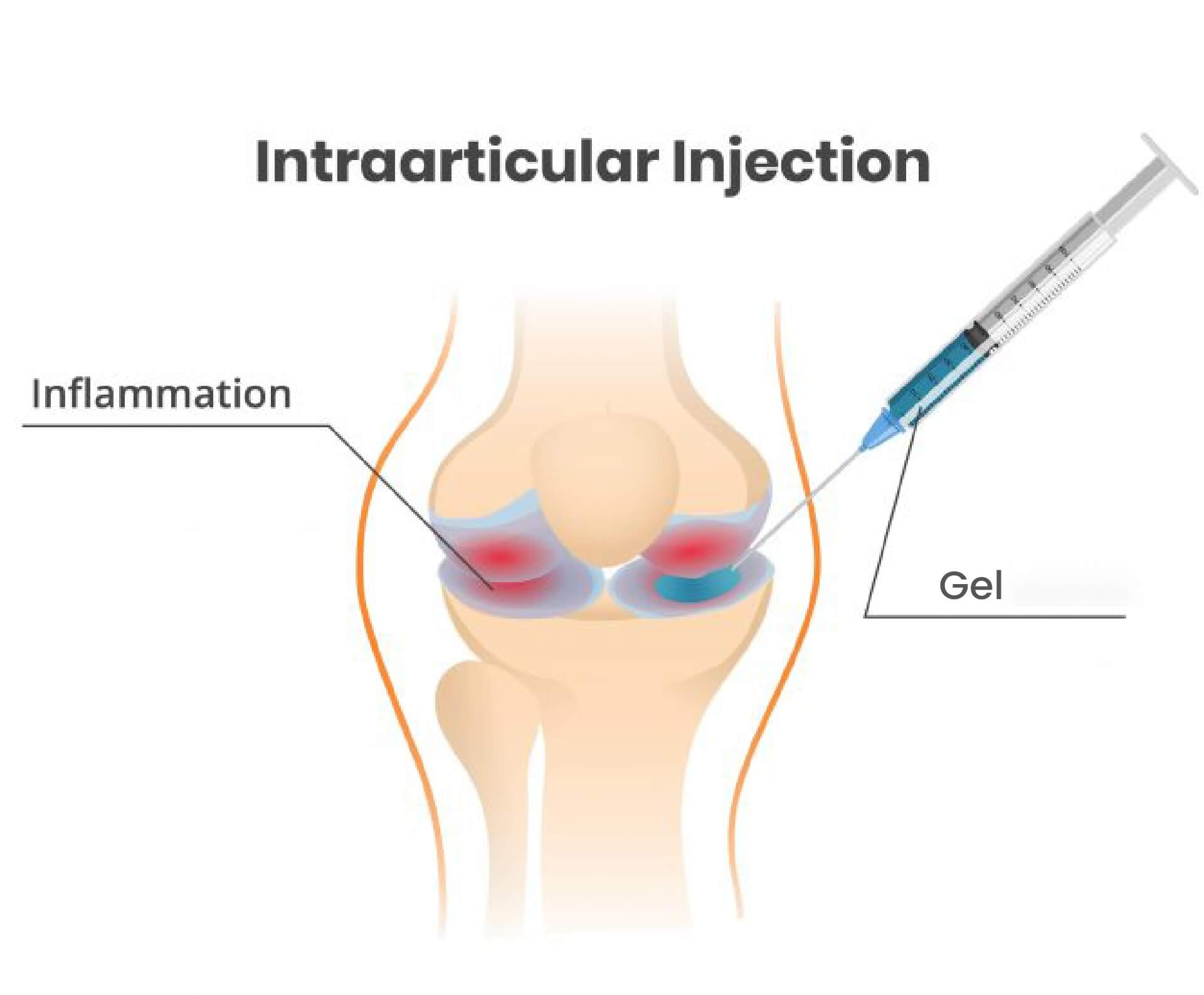 Intraarticular Gel injections (Viscosupplementation) Pain Management