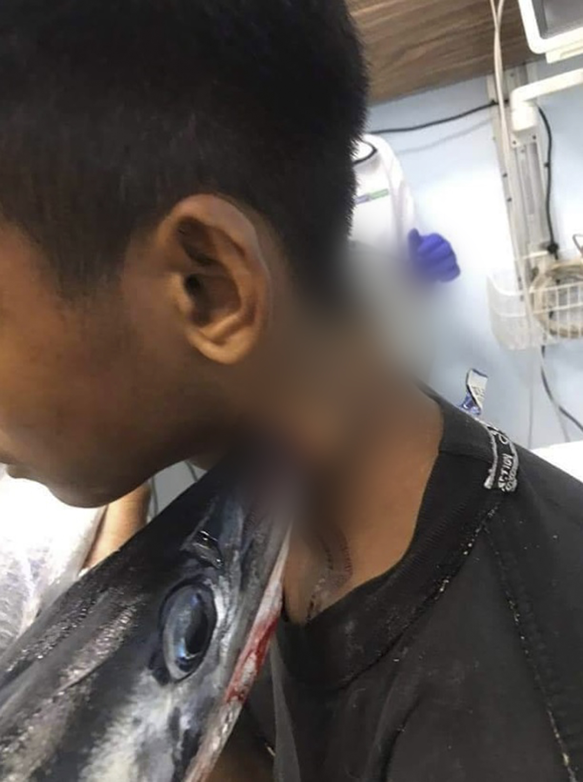 Teen Lucky To Be Alive After Fish Jumps In Boat Stabs Him In Neck