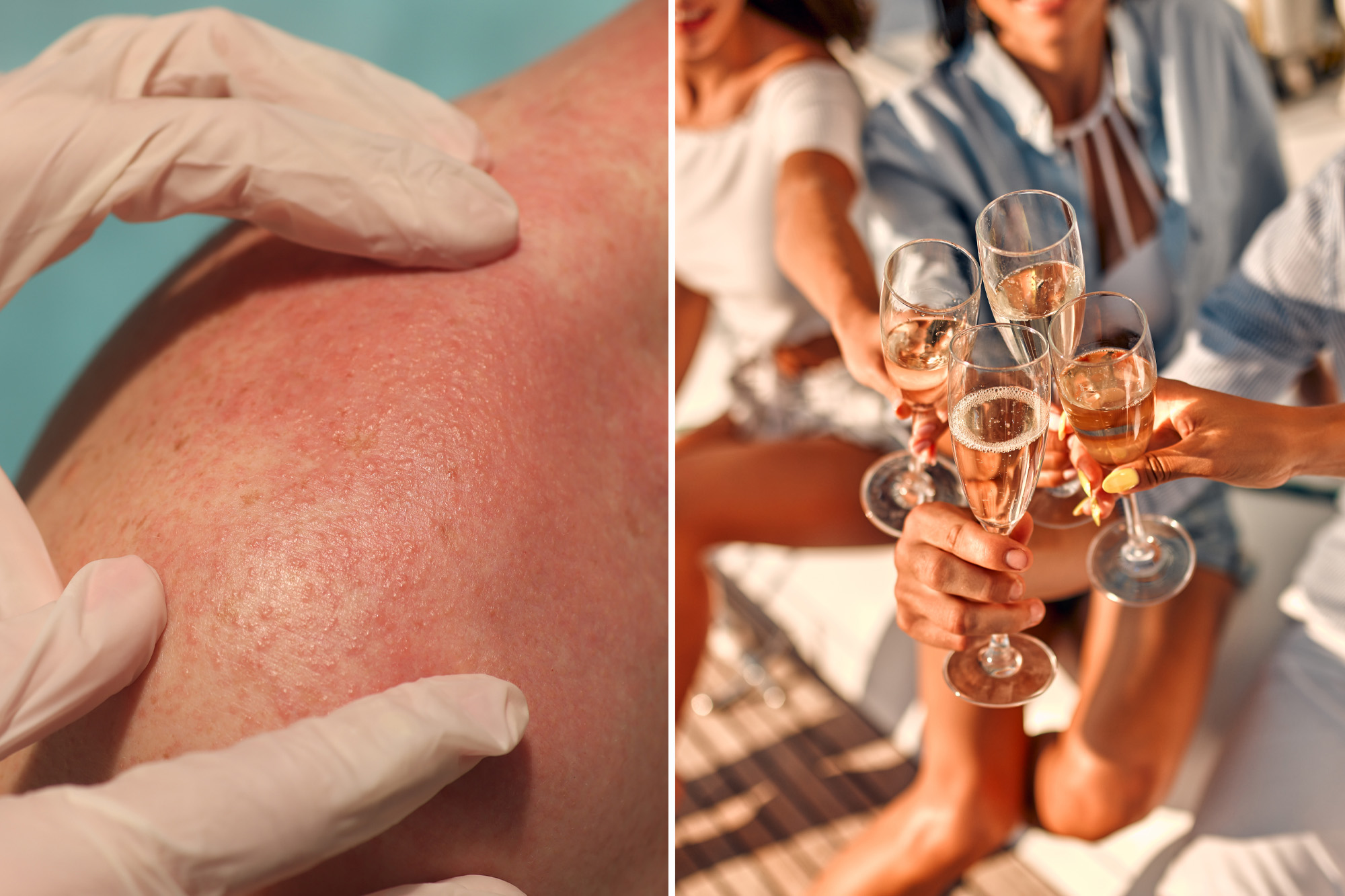 Uptick in Unsightly Disease Noticed in Wealthy Regions
